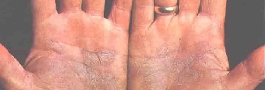 psoriasis palmo-plantaire